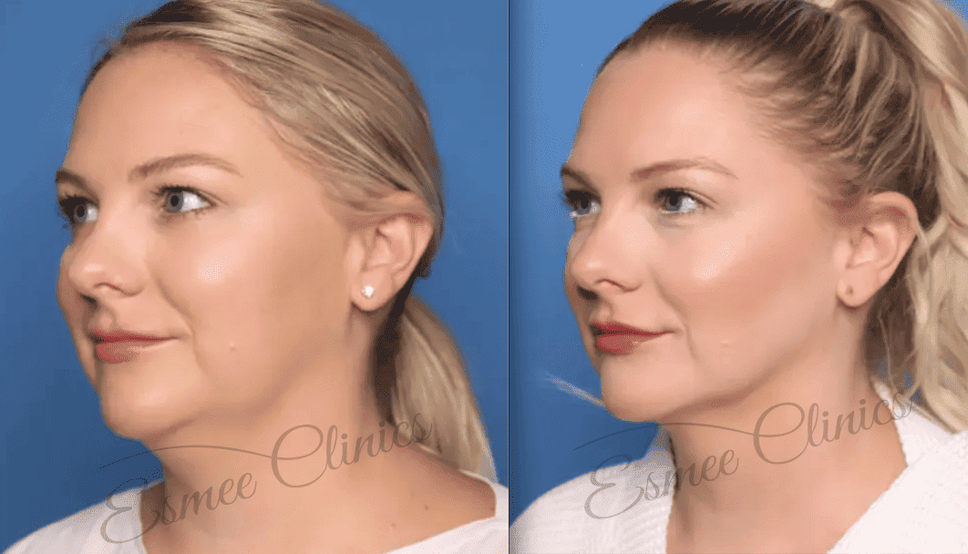 Before and After img